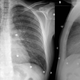 Chest x-ray pre-treatment (PA and side)