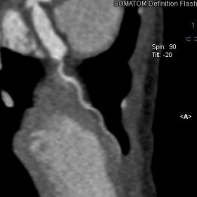 CT Coronary Angiography