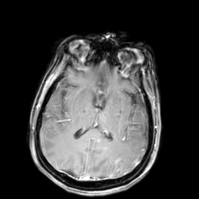 Brain MRI. T1 post-contrast.