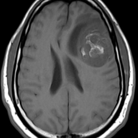 MRI Axials T1,T2, Post-Gd, DWI, ADC, rCBV
