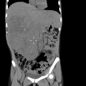CT scan of the whole abdomen with IV contrast