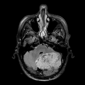 T2W/FLAIR images of dysplastic gangliocytoma