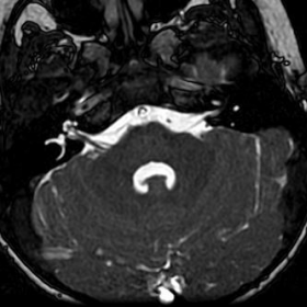 MRI Brain axial FIESTA nerve sequence