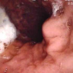 Upper digestive endoscopy