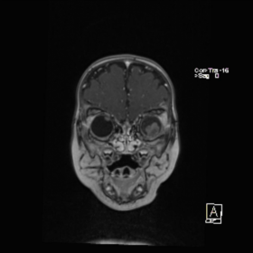 MRI of the head, December 2016, coronal plane