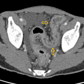 CT abdomen and pelvis with contrast (axial)