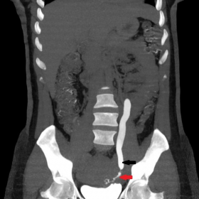 CT excretory urography images
