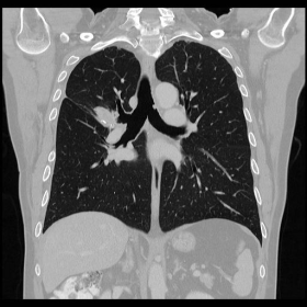 Contrast-enhanced CT of the lung