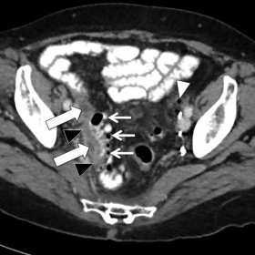 Ileal diverticulitis and small-bowel diverticulosis (previous CT)