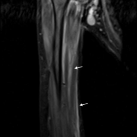 MRI bilateral arms