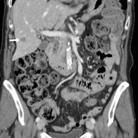 Contrast-enhanced multidetector CT (oncologic follow-up)
