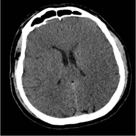 Brain CT images