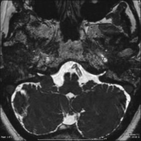 Axial MRI without contrast