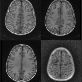 MRI Brain T1 weighted