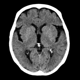 Cranial CT without IVC