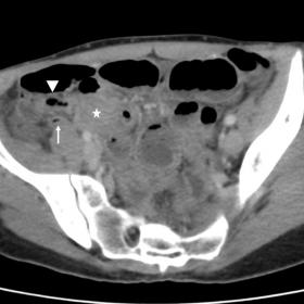 Contrast-enhanced CT image shows a soft-tissue mass (star) with moderate enhancement in the right iliac fossa. We identify a 