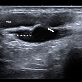 Ultrasonography image of the right radial artery (sagittal view) shows AV fistula (arrow) connecting the radial artery to the