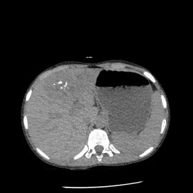 A heterogeneously hypodense mass lesion is seen in liver on non-contrast axial computed tomography (CT). Few coarse central c