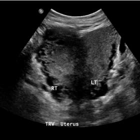 Transverse view of the uterus with two cavities.