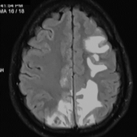 (A-C) Axial FLAIR images reveal confluent white matter hyperintensity in bilateral parieto-occipital region, left frontal reg