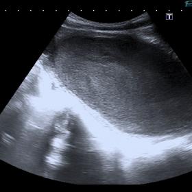 Large pelvic fluid collection with low-level echoes, probably located at the right horn of a bicornuate uterus.