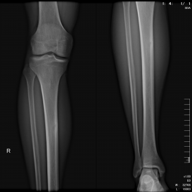 Radiographic AP-view of the right tibia demonstrating an approximately 10 mm sharply delineated cortical lucency centrally in