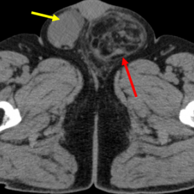 CT appearance of spermatic cord liposarcoma. Axial CT image shows an extratesticular mass composed almost entirely of fat (re
