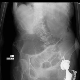 Abdominal x-ray: Acute dilatation of stomach, dilated loops of small intestines and gas fluid levels