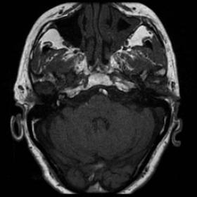 Axial magnetic resonance imaging showed a hyperintensity in the right cochlea and vestibule in the precontrast T1-weighted im