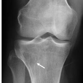 Right knee X-rays in AP (A) and L views (B) showing an eccentric medullary osteolytic lesion in the posterolateral aspect of 