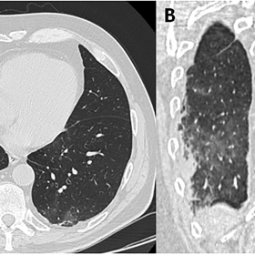 Axial (A) and coronal (B) HRCT images show diffuse ground-glass attenuation in the postero-inferior segment of the right lobe