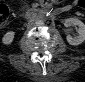 CT acquisition on the axial plane after intravenous contrast administration, depicting duodenal wall thickening and discontin