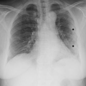 Anteroposterior chest x-ray of a patient infected with COVID-19 that shows consolidations