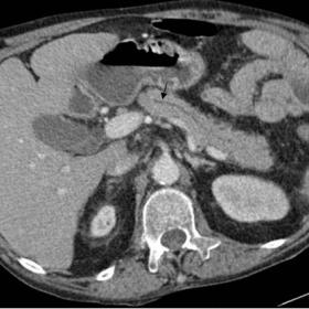 Baseline CT scan shows dilatation of pancreatic duct (black arrow in a), duodenal haematoma (asterisk in b, c and e), inflamm
