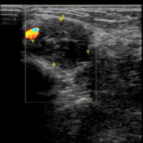 Ultrasonography image showing mass posterior to the medial malleolus of the right ankle.