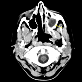 Maxillary and ethmoidal sinusitis. Enhanced CT with soft tissue window (axial).