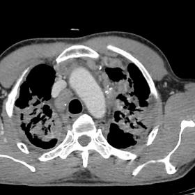 Axial CT of thorax showing eggshell calcification within the masses and lymph nodes