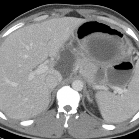 Abdominal contrast-enhanced computed tomography image in the axial plane