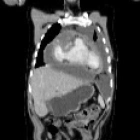 CT Whole Body showing diffuse irregular pericardial thickening with subtle small nodules.