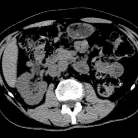 Pre-contrast scan. On axial plane the renal mass is is attenuating to the surrounding parenchyma.