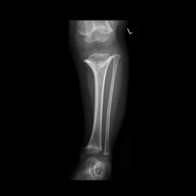 AP and lateral radiographs of the left leg demonstrate partial fusion of the growth plates of the left lower limb, with coned