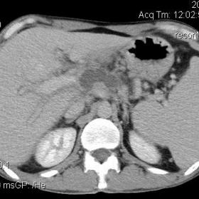 CT before the treatment. Pancreatic pseudocyst