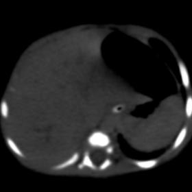 Unenhanced phase shows an ill defined isodense lesion in right lobe of liver with central area of hypodensity. No calcificati