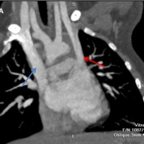 Coronal reformatted image. A double superior vena cava with the left superior vena cava (red arrow) draining into the left at
