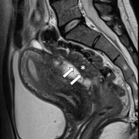 Sagittal T2-weighted image shows thickening and distortion of the anterior rectal wall (straight arrows) with low signal inte