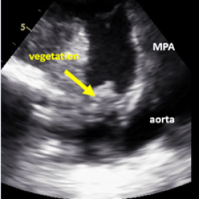 echocardiography, supra-sternal view revealed an out pouch connecting aorta and main pulmonary artery with on top vascular ma