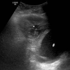 Axial abdominal and pelvic computed tomography (CT) shows a left inguinal hernia containing part of the bladder that has irre