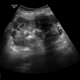 Ultrasound image shows the right kidney with lobulated contours caused by multiple parenchymal nodular lesions with exophytic