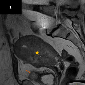 Sagittal T2-weighted image shows an intermediate to high signal intensity tumour distending the endometrial cavity (star). Th