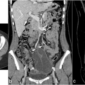 Multiplanar axial (a), coronal (b) and sagittal contrast-enhanced CT view show a well-defined, low-attenuation cystic mass (a
